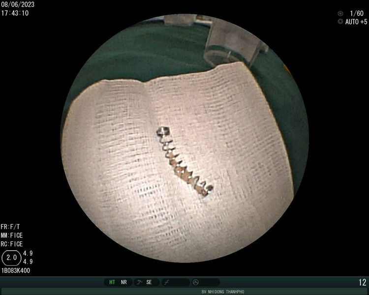 Chiếc lò so bút được lấy ra