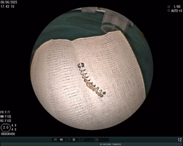 Chiếc lò so bút được lấy ra