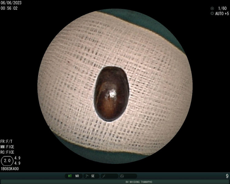 Hạt mãng cầu gây bít tắc đường thở của cô bé mãng cầu