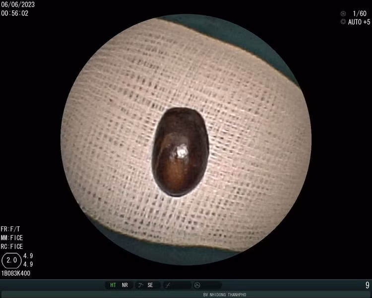 Hạt mãng cầu gây bít tắc đường thở của cô bé mãng cầu