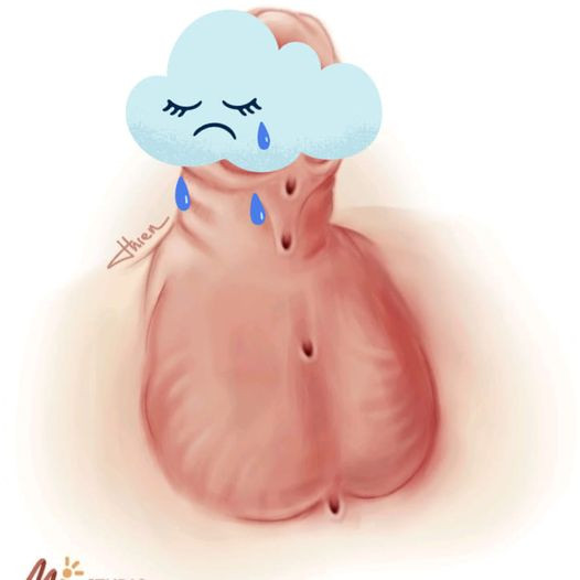 Biểu hiện của dị tật lỗ tiểu thấp