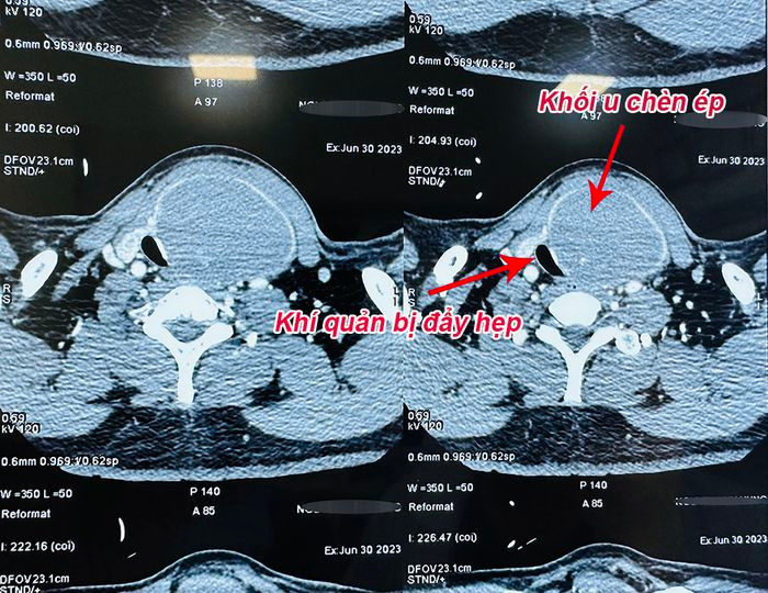 Chủ quan với u giáp lành tính người đàn ông 55 tuổi gặp nguy tính mạng