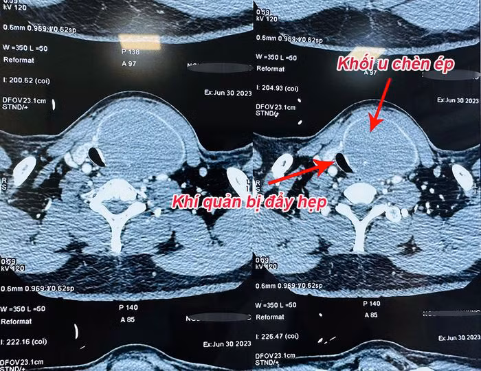 Chủ quan với u giáp lành tính người đàn ông 55 tuổi gặp nguy tính mạng