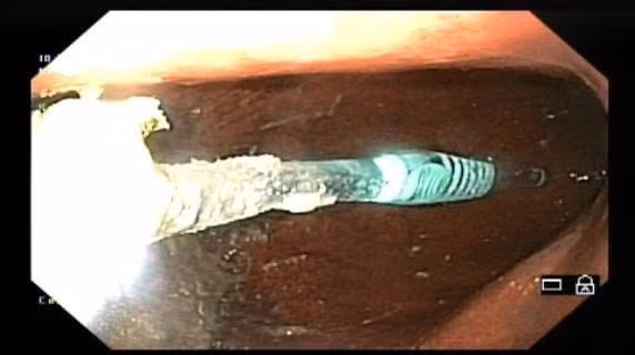 Bàn chải đánh răng trong dạ dày bệnh nhân- Ảnh BVCC