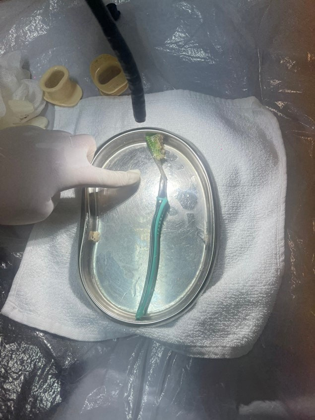 Chiếc bàn chái đánh răng được các bác sĩ lấy ra - Ảnh BVCC