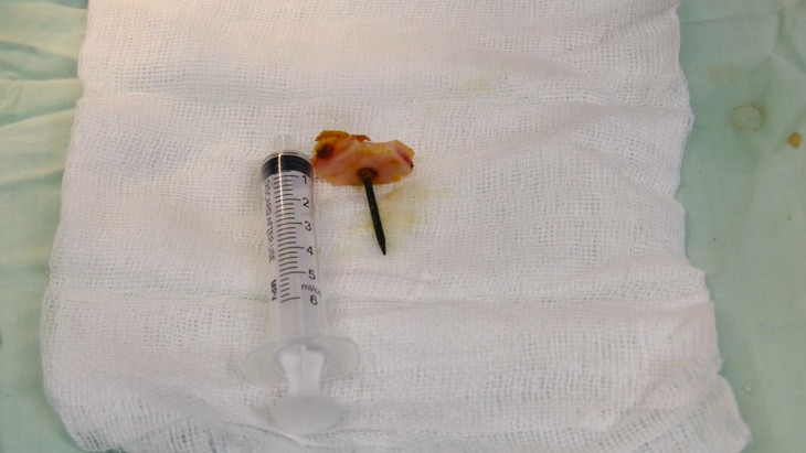 Chiếc đinh dài 4 cm đã được lấy ra khỏi hộp sọ bệnh nhân - Ảnh BVCC