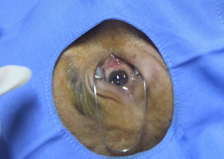 Không chủ quan với những trường hợp va đập vào mắt dù vết thương không thấy rõ hoặc rất nhỏ