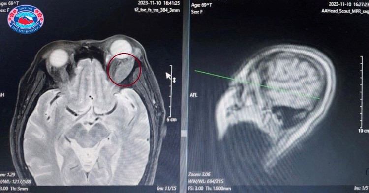 Vị trí khối u trên kết quả chụp cộng hưởng từ sọ não