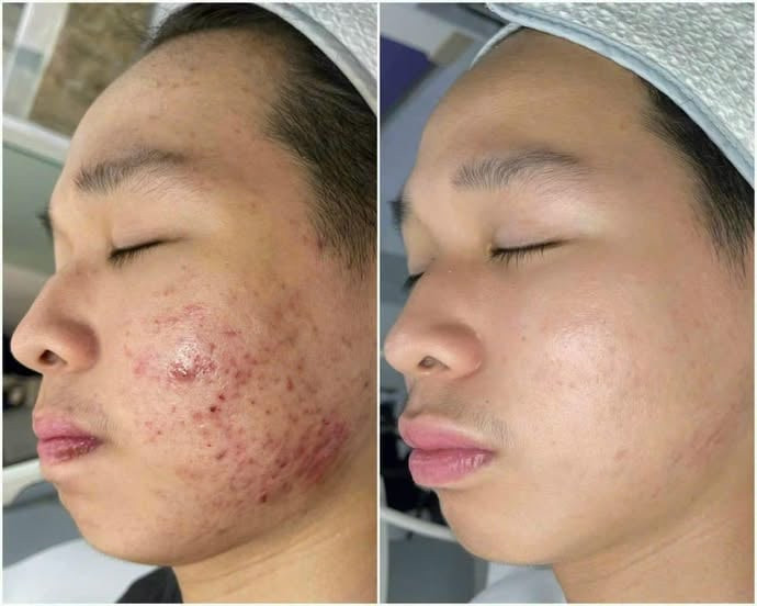 Trị mụn cần kiên trì, tuân thủ đúng phác đồ của bác sĩ. Ảnh: BSCC