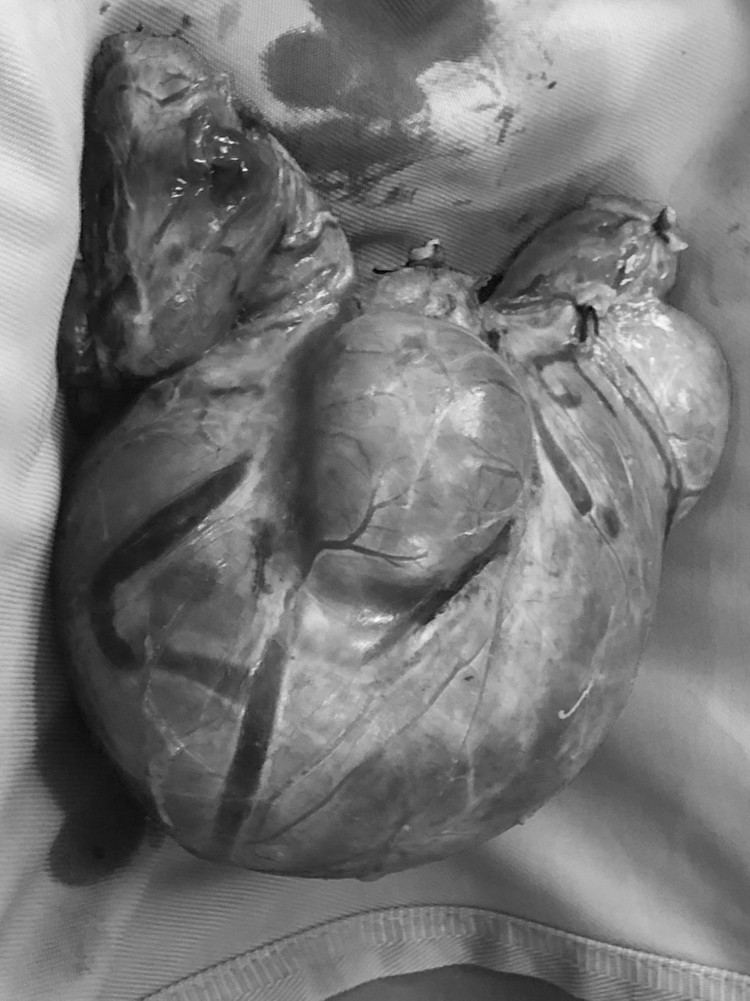 Khối bướu cổ khổng lồ được lấy ra