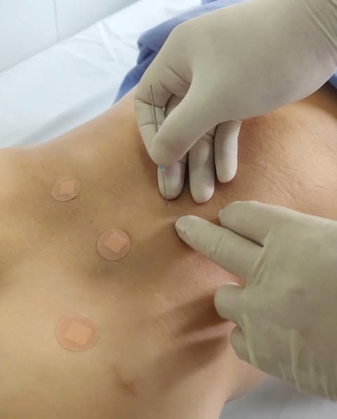 Cấy chỉ cho bệnh nhân - Ảnh BVCC Cấy chỉ cho bệnh nhân - Ảnh BVCC