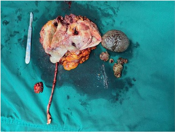 Khối ung thư và sỏi thận của bệnh nhân được lấy ra - Ảnh BVCC