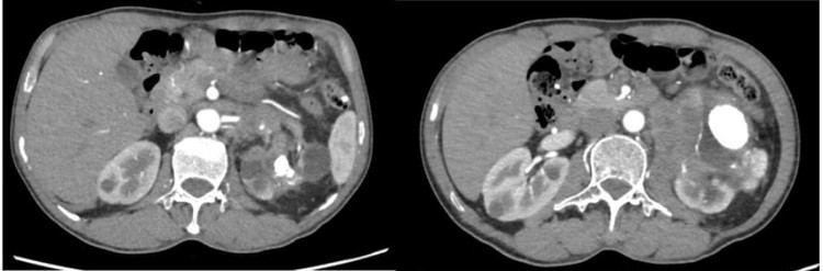 Hình ảnh phim chụp cắt lớp ổ bụng có sỏi thận và khối u thận của người bệnh - Ảnh BVCC