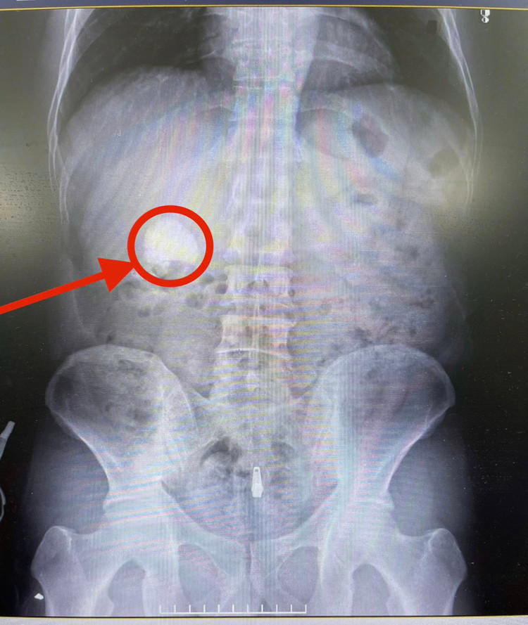 Hình ảnh sỏi thận trên phim chụp - Ảnh BVCC