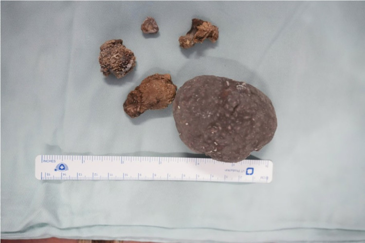 Người đàn ông 64 tuổi bị sỏi thận lâu năm biến chứng ung thư ảnh 3