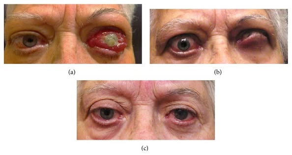 Biến chứng mắt đe dọa thị lực - Ảnh BSCC