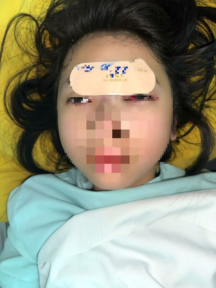 Bệnh nhân 14 tuổi suýt mù mắt vì tự tiêm filer tại nhà