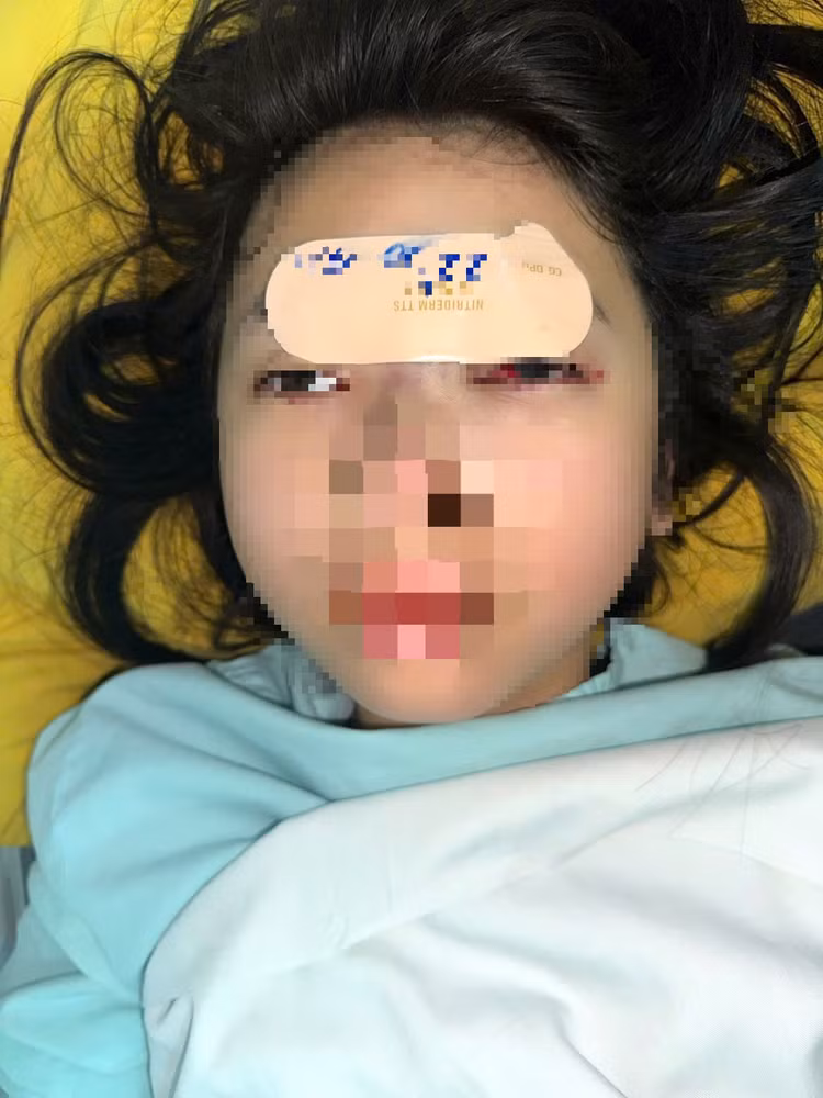 Bệnh nhân 14 tuổi suýt mù mắt vì tự tiêm filer tại nhà