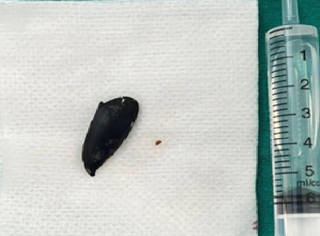 Ho, khó thở suốt 3 tháng mới phát hiện mắc hạt hồng xiêm trong phế quản ảnh 3