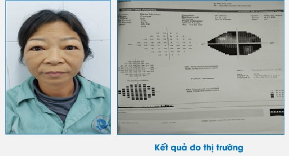 Mất thị lực vĩnh viễn vì Basedow biến chứng mắt? ảnh 1