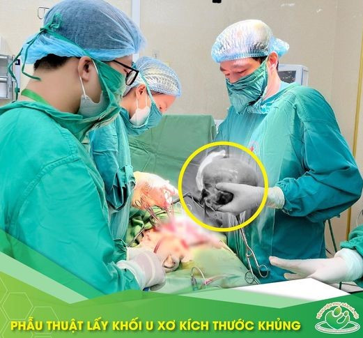 U xơ tử cung tuy lành tính nhưng gây nhiều biến chứng