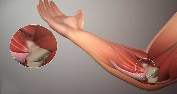 Đau khuỷu tay tenis là hội chứng thường gặp ở người chơi thể thao