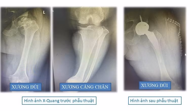 Hình ảnh chụp cận lâm sàng X-quang trước và sau trước phẫu thuật của người bệnh P.T.C