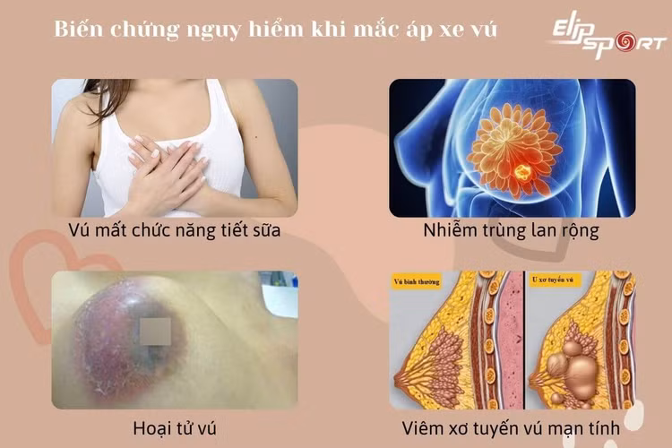 Tắc tia sữa và áp xe vú