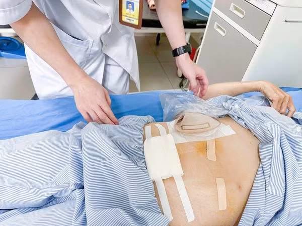 Thói quen ngâm tăm, nữ bệnh nhân bị tăm tre xuyên thủng đại tràng