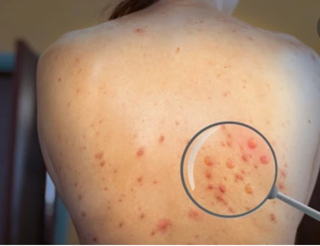 Phát hiện ca đậu mùa khỉ thứ 6 tại Việt Nam Phát hiện ca đậu mùa khỉ thứ 6 tại Việt Nam