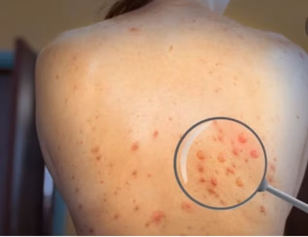 Phát hiện ca đậu mùa khỉ thứ 6 tại Việt Nam