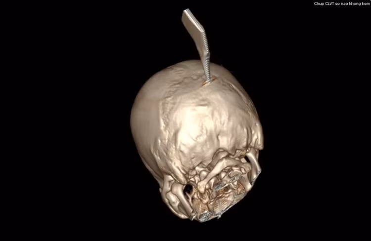 Dựng hình 3D đánh giá hộp sọ, tổn thương và dị vật.