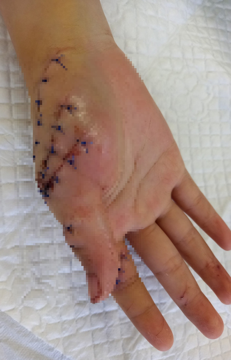 Bất cẩn cô gái 17 tuổi bị máy xay cắt 7 vết thương sâu tận gân