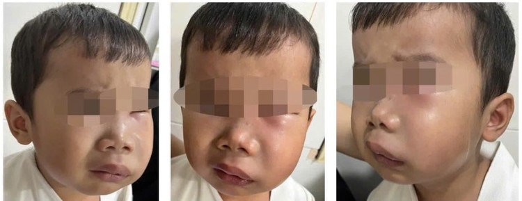 Trẻ bị sâu răng biến chứng viêm tủy răng - Ảnh BVCC