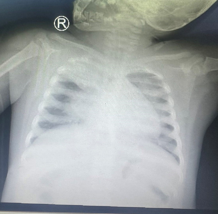 Xquang phổi: tổn thương lan tỏa 2 bên phổi, xẹp đỉnh phổi (P) - Ảnh: BVCC