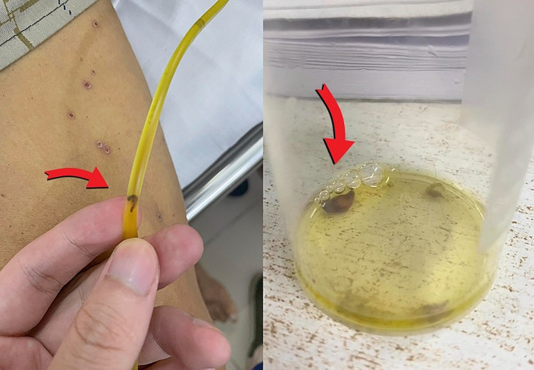 Hình ảnh sán lá gan chui ra từ ống dẫn lưu đường mật!