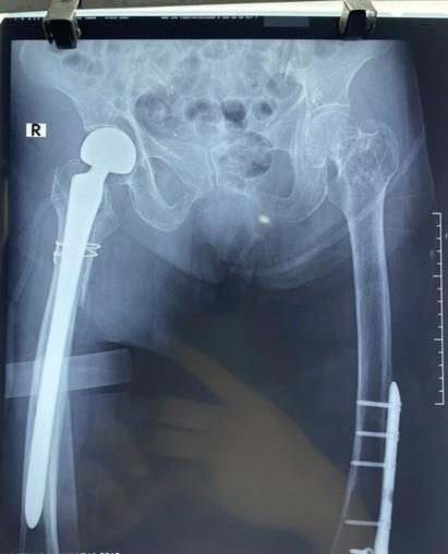 Hình ảnh sau phẫu thuật thay khớp háng