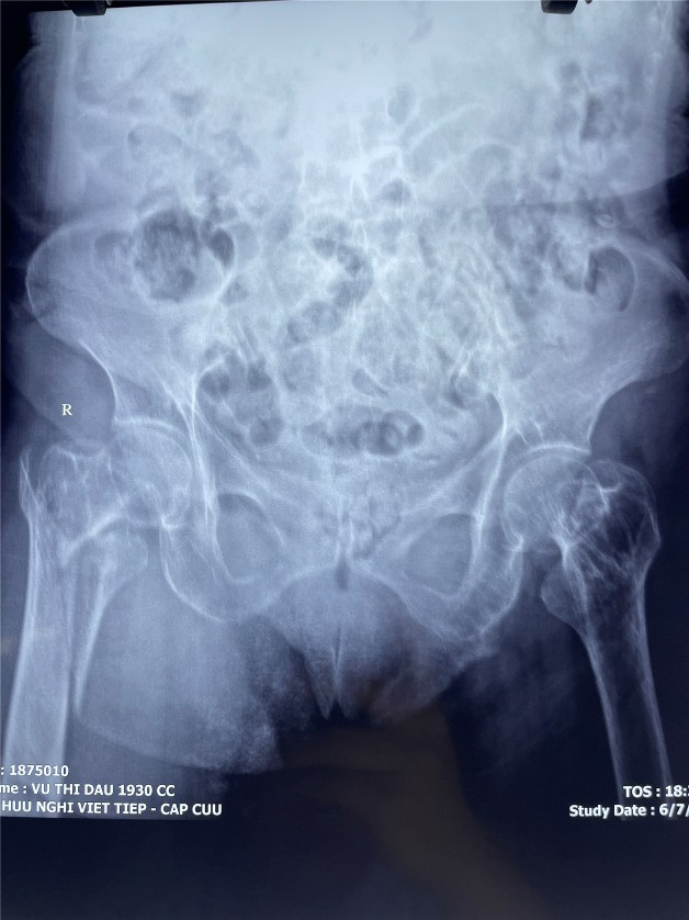 Gãy khối máu chuyển xương đùi của người bệnh trước phẫu thuật