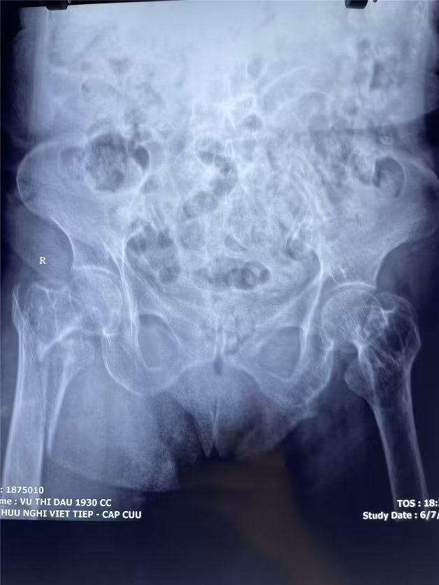 Gãy khối máu chuyển xương đùi của người bệnh trước phẫu thuật