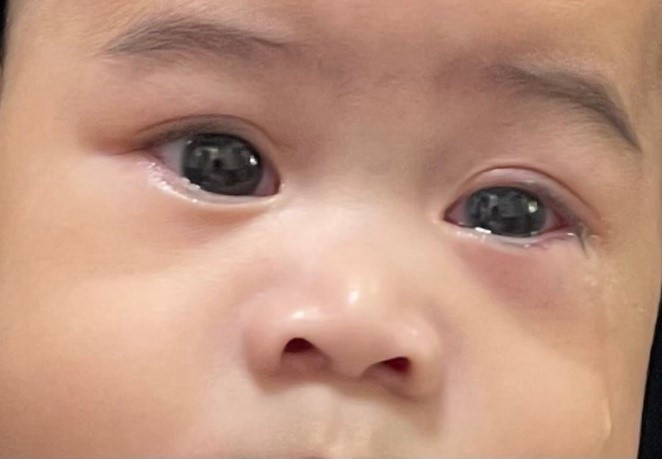 Viêm kết mạc cấp 2 mắt