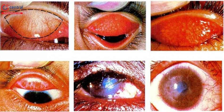 Các hình thái của đau mắt đỏ