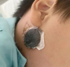 Trẻ nhập viện với miếng cao dán tại vùng da góc hàm - Ảnh BVCC