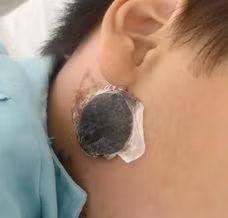 Trẻ nhập viện với miếng cao dán tại vùng da góc hàm - Ảnh BVCC