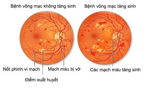 Bong võng mạc đái tháo đường