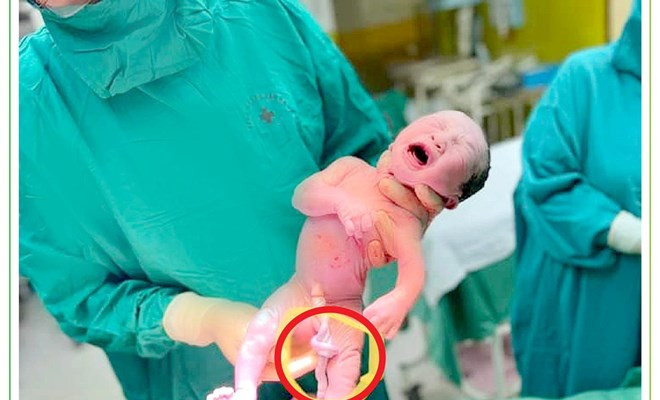 Trẻ bị dây rốn thắt nút được bắt thai an toàn tại Bệnh viện Phụ sản Hà Nội - Ảnh BVCC