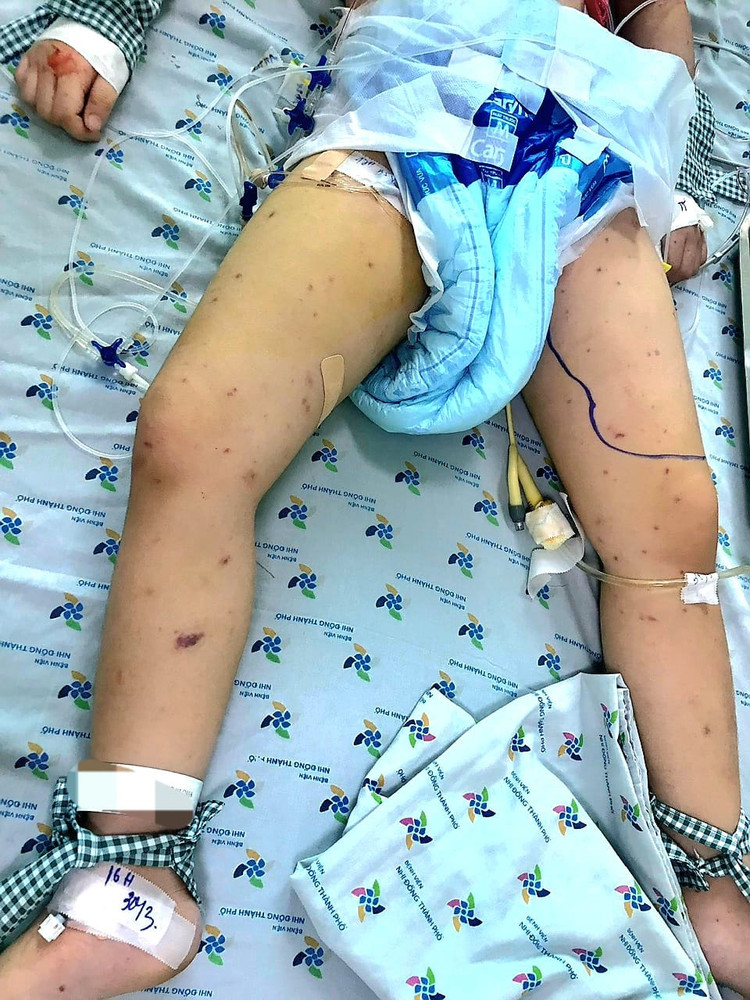 Trẻ nôn ban đỏ nguy kịch do viêm não mô cầu - Ảnh BVCC