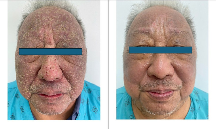 Hình ảnh người bệnh trước và sau 5 ngày điều trị