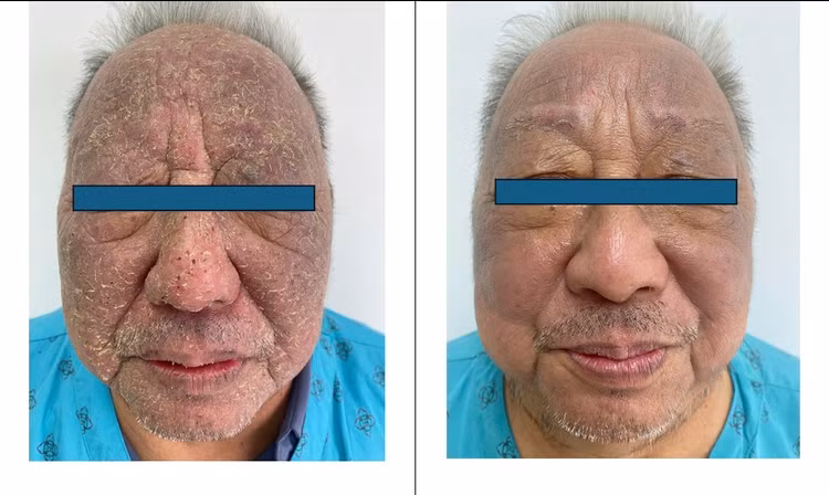 Hình ảnh người bệnh trước và sau 5 ngày điều trị