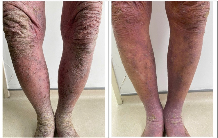 Hình ảnh người bệnh trước và sau 5 ngày điều trị