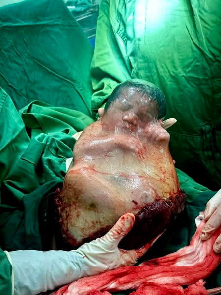 Em bé đầu năm sinh bọc điều với tỷ lệ hy hữu 1/80.000 ca ảnh 2